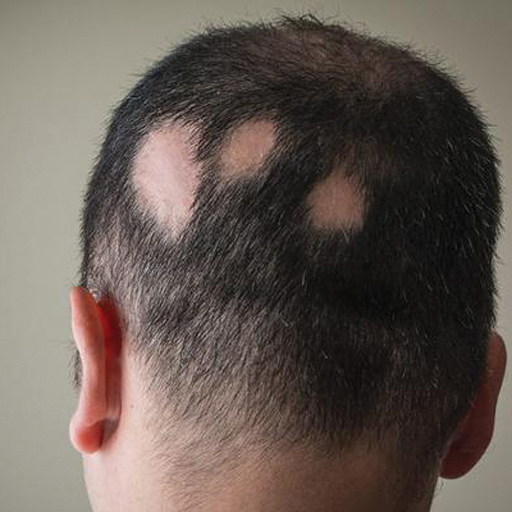 Alopecia areata